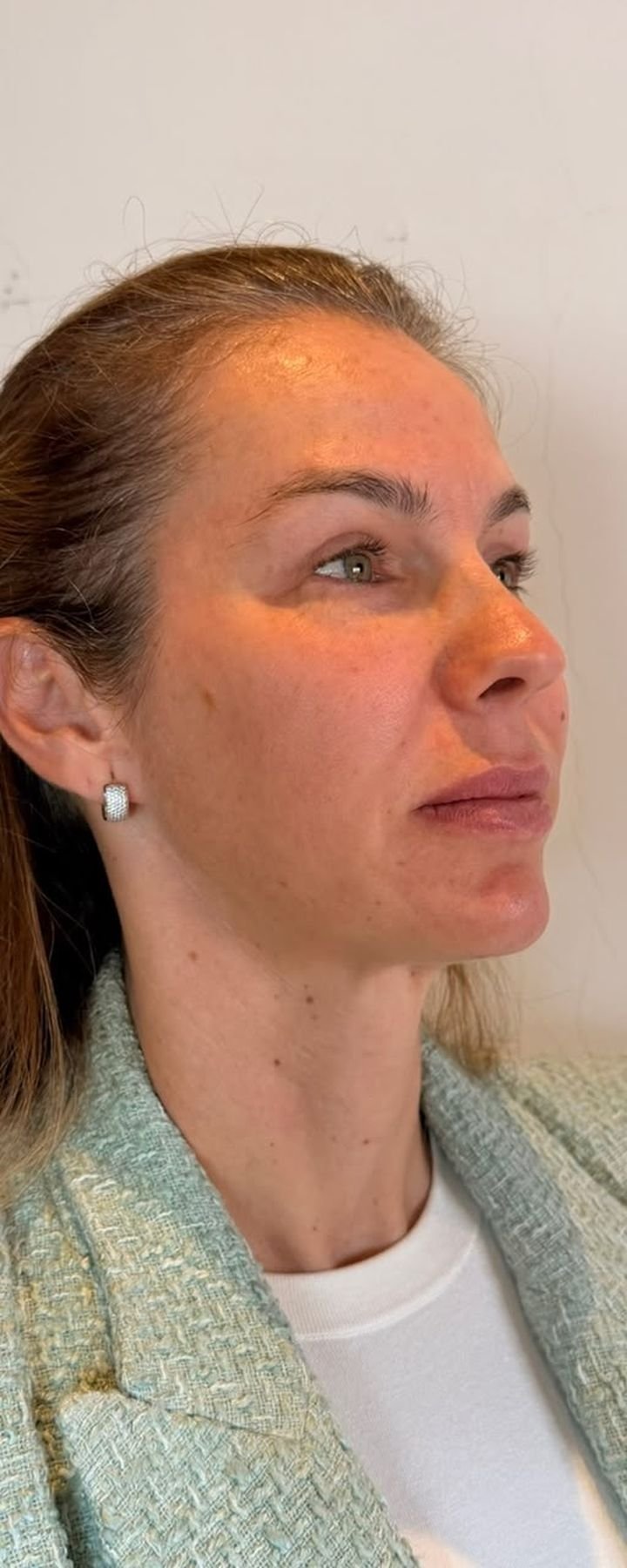 Antes — Full Face — contorno mandibular e projeção do perfil