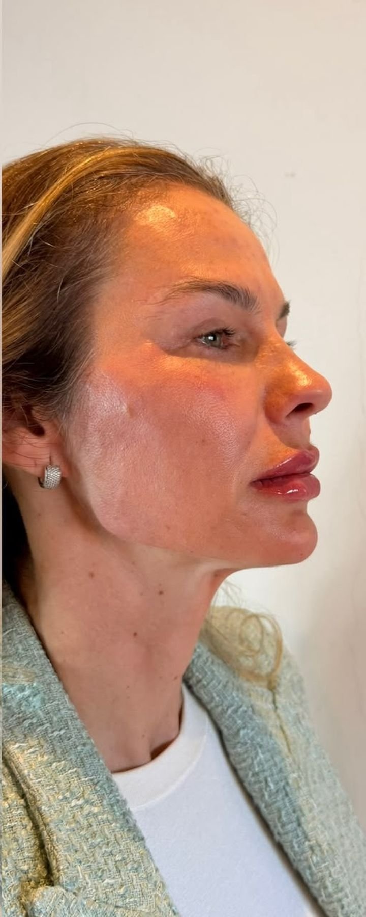 Depois — Full Face — contorno mandibular e projeção do perfil