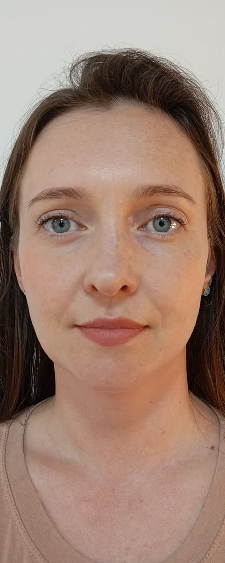 Antes — Full Face — equilíbrio dos terços e definição labial