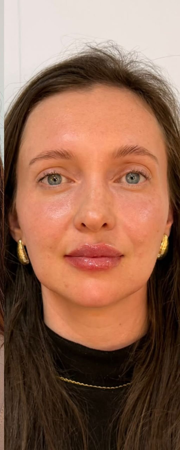 Depois — Full Face — equilíbrio dos terços e definição labial