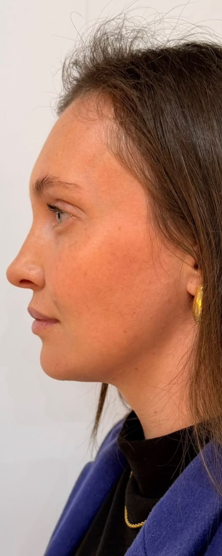 Antes — Full Face — perfil harmônico e definição do ângulo cervical