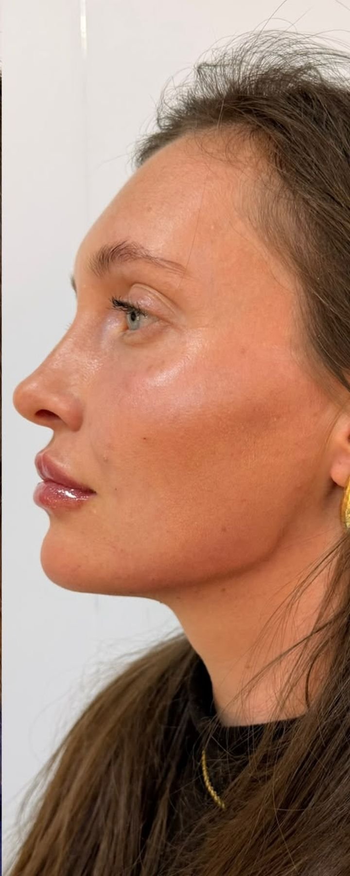 Depois — Full Face — perfil harmônico e definição do ângulo cervical